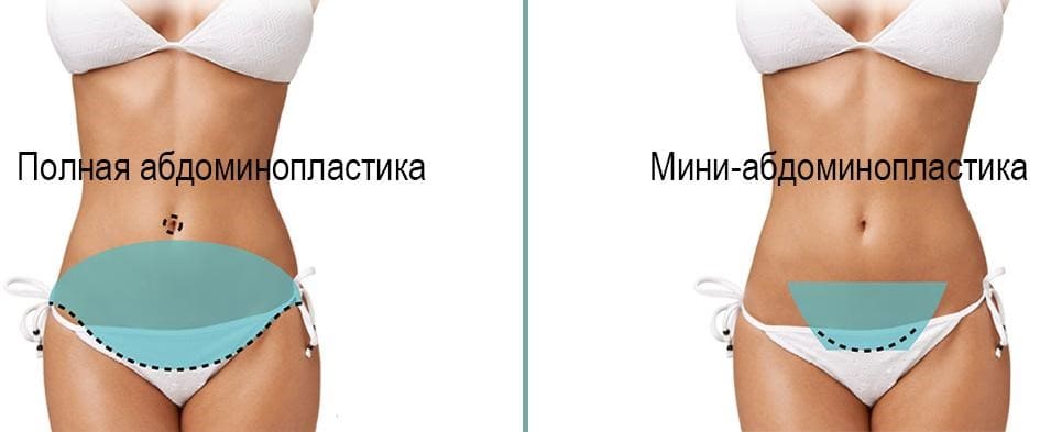 miniabdo.jpg